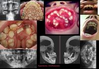 Hyperdontia